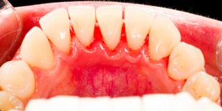 스타치과 치아관리 프로그램 2